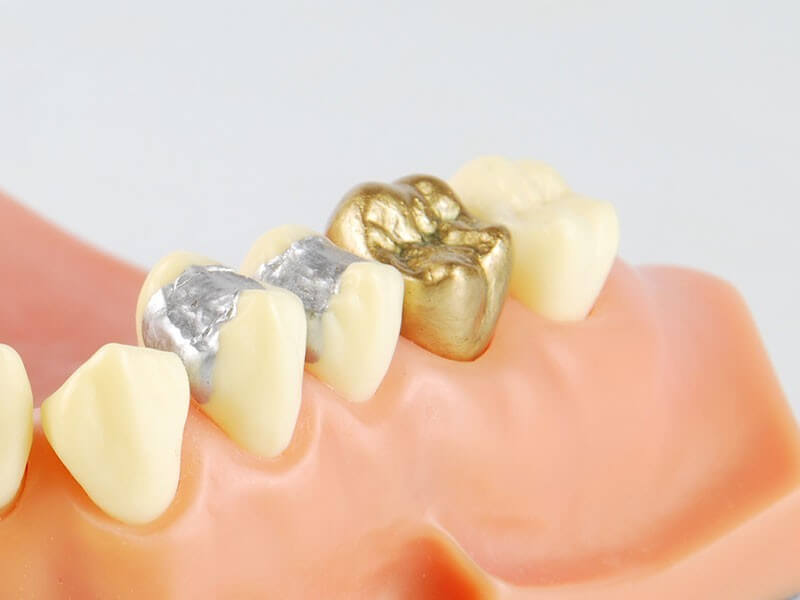 استفاده از طلا در پر کردن دندان هزینه بسیار بالایی دارد و اغلب استفاده نمی‌شود.