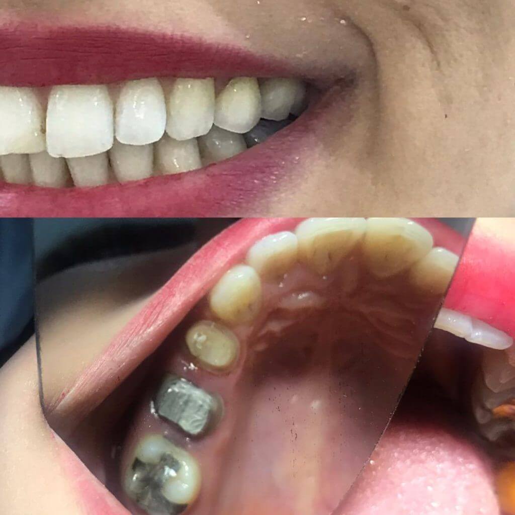 استحکام مواد مختلف برای پر کردن دندان متفاوت است.
