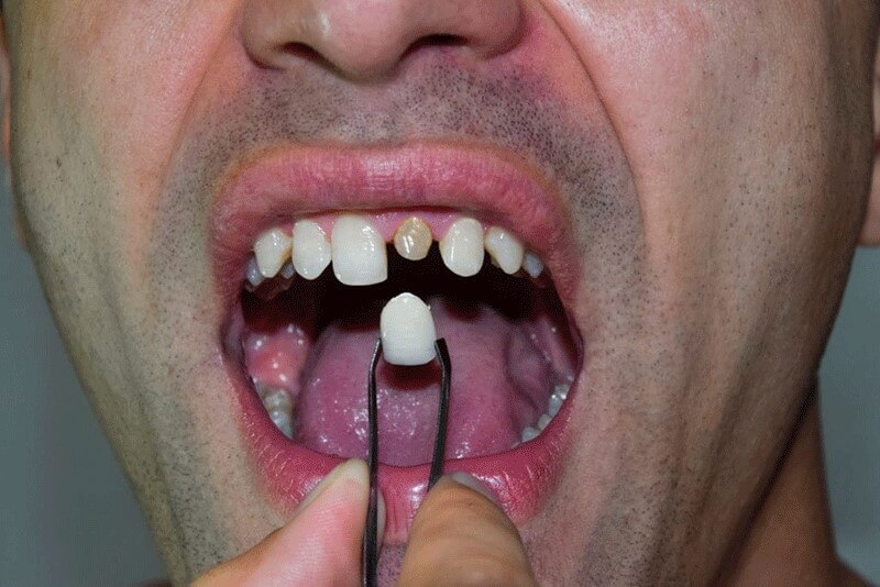 مواد مورد استفاده برای پر کردن دندان در کودکان با بزرگسالان متفاوت است.